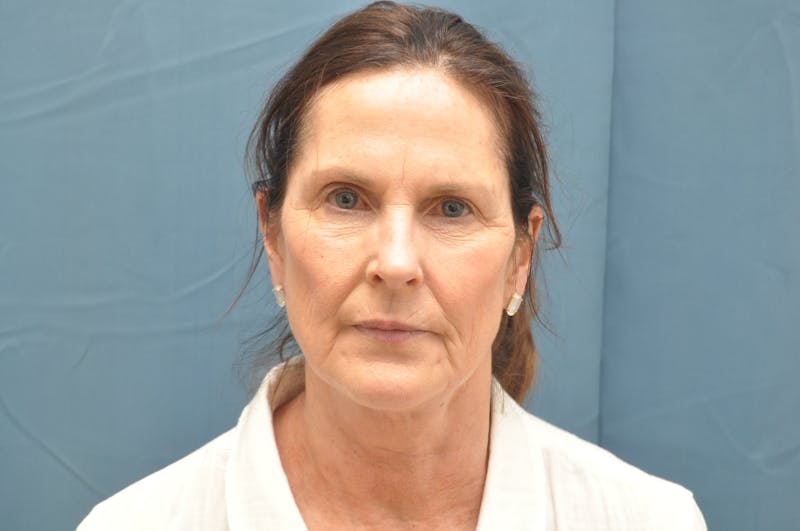 Facelift Before & After Gallery - Patient 148101361 - Image 1