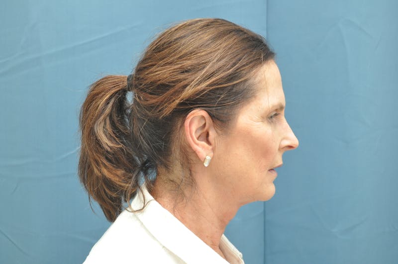 Facelift Before & After Gallery - Patient 148101361 - Image 5
