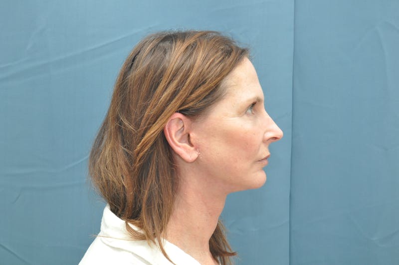 Facelift Before & After Gallery - Patient 148101361 - Image 6