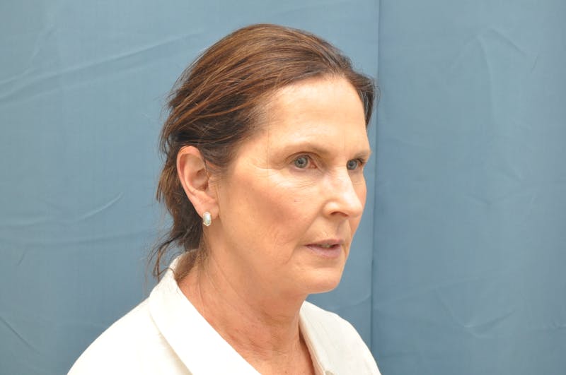 Facelift Before & After Gallery - Patient 148101361 - Image 3
