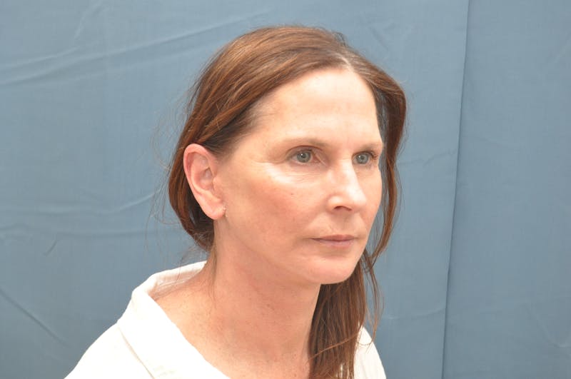 Facelift Before & After Gallery - Patient 148101361 - Image 4