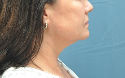 Liposuction Before & After Gallery - Patient 148101366 - Image 1