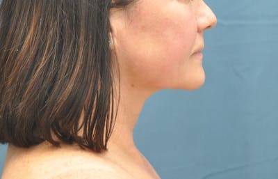 Liposuction Before & After Gallery - Patient 148101366 - Image 2