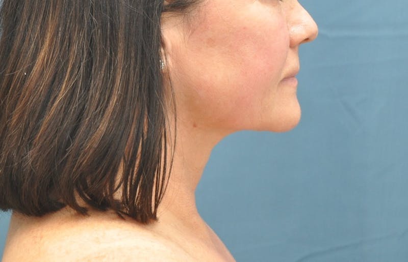 Liposuction Before & After Gallery - Patient 148101366 - Image 2