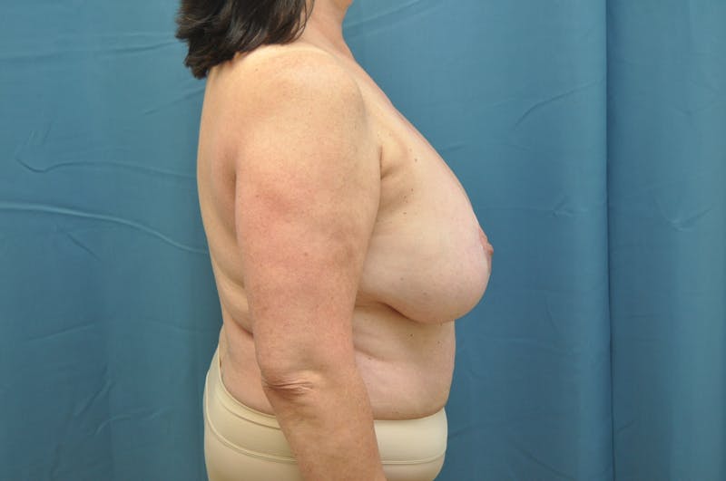 Breast Implant Removal Before & After Gallery - Patient 148101369 - Image 3
