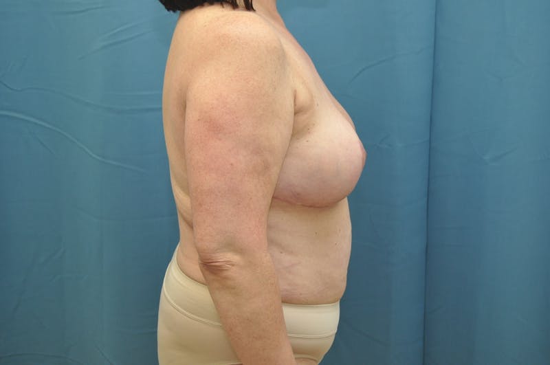 Breast Implant Removal Before & After Gallery - Patient 148101369 - Image 4