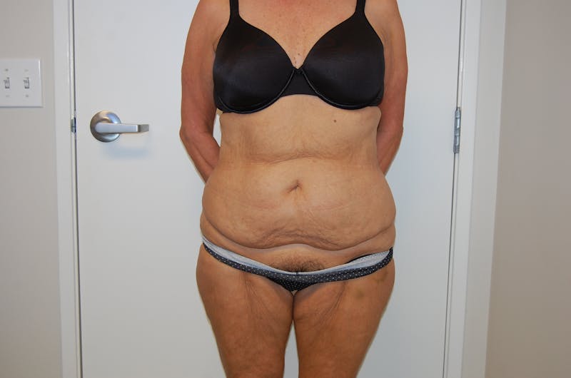 Body Lift Before & After Gallery - Patient 120352950 - Image 1