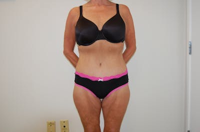 Body Lift Before & After Gallery - Patient 120352950 - Image 2