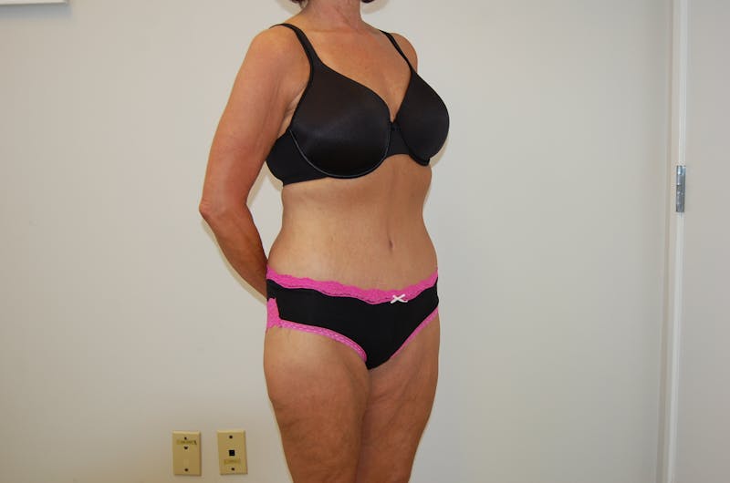 Body Lift Before & After Gallery - Patient 120352950 - Image 4