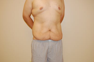 Body Lift Before & After Gallery - Patient 120352955 - Image 1