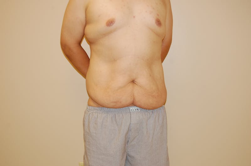 Body Lift Before & After Gallery - Patient 120352955 - Image 1