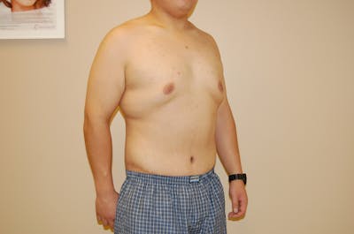 Body Lift Before & After Gallery - Patient 120352955 - Image 2