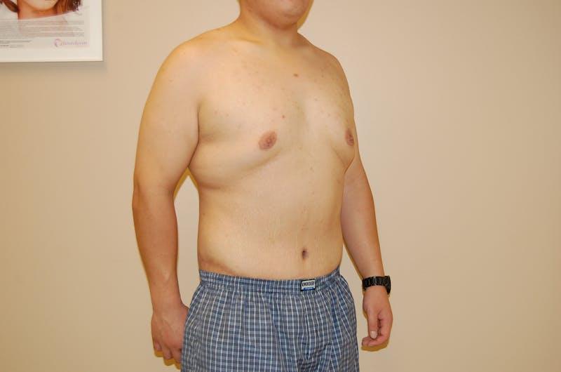 Body Lift Before & After Gallery - Patient 120352955 - Image 2