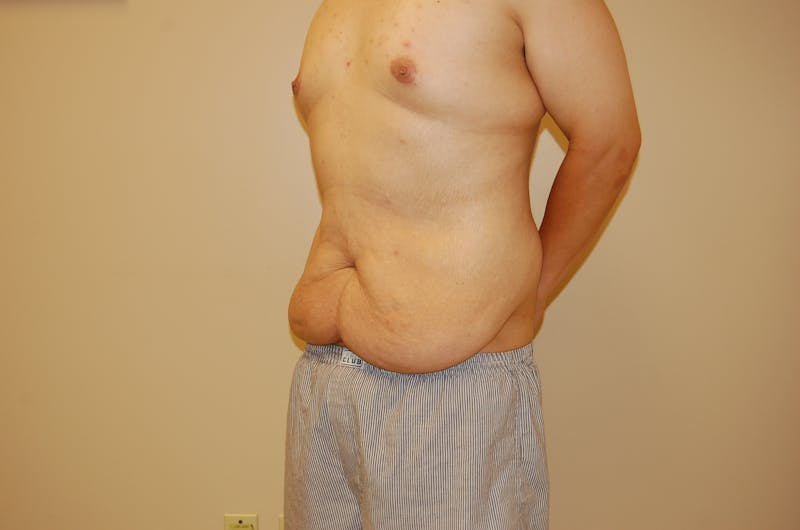 Body Lift Before & After Gallery - Patient 120352955 - Image 5