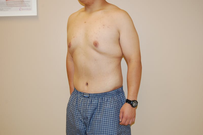 Body Lift Before & After Gallery - Patient 120352955 - Image 6