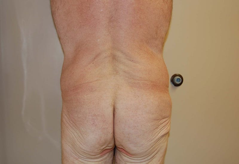 Body Lift Before & After Gallery - Patient 148338374 - Image 3
