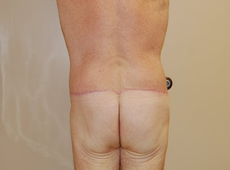 Body Lift Before & After Gallery - Patient 148338374 - Image 4