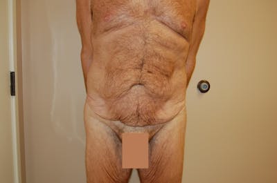 Body Lift Before & After Gallery - Patient 148338374 - Image 1
