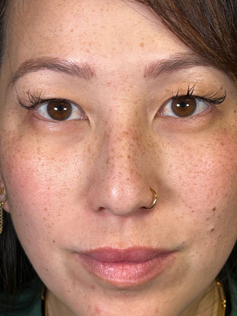 BBL/Moxi Before & After Gallery - Patient 161318315 - Image 1