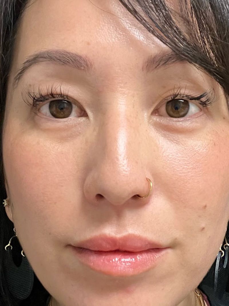 BBL/Moxi Before & After Gallery - Patient 161318315 - Image 2