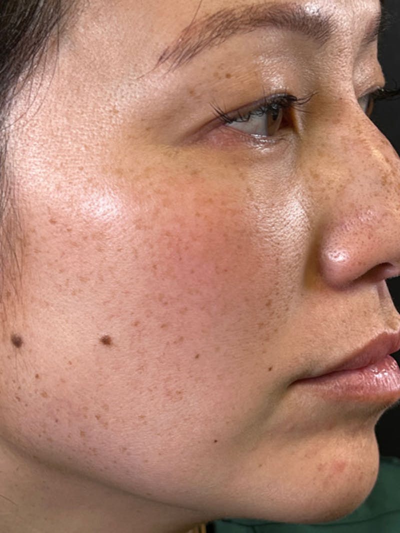 BBL/Moxi Before & After Gallery - Patient 161318315 - Image 3