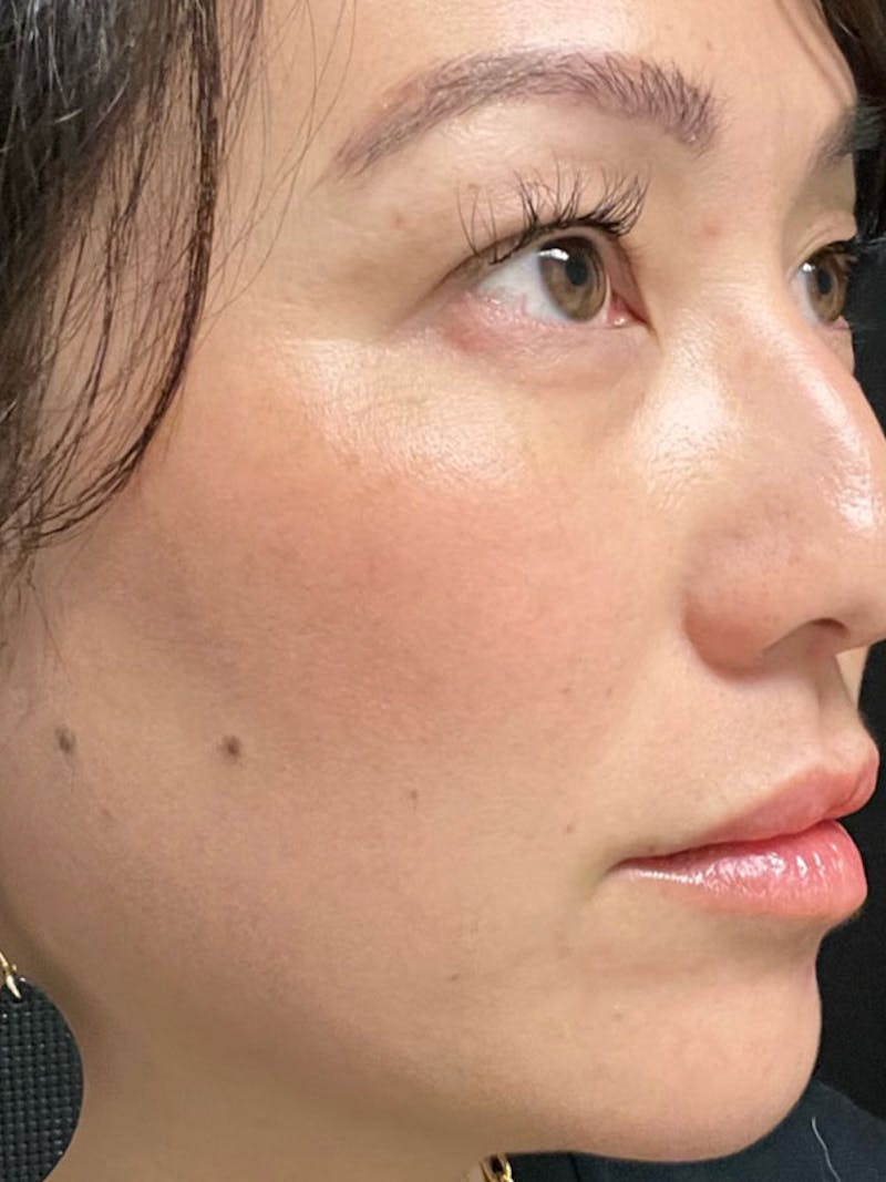 BBL/Moxi Before & After Gallery - Patient 161318315 - Image 4