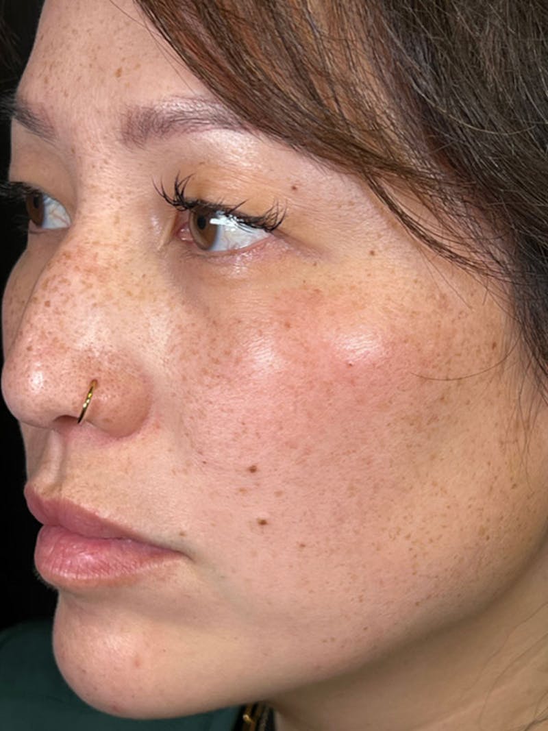 BBL/Moxi Before & After Gallery - Patient 161318315 - Image 5