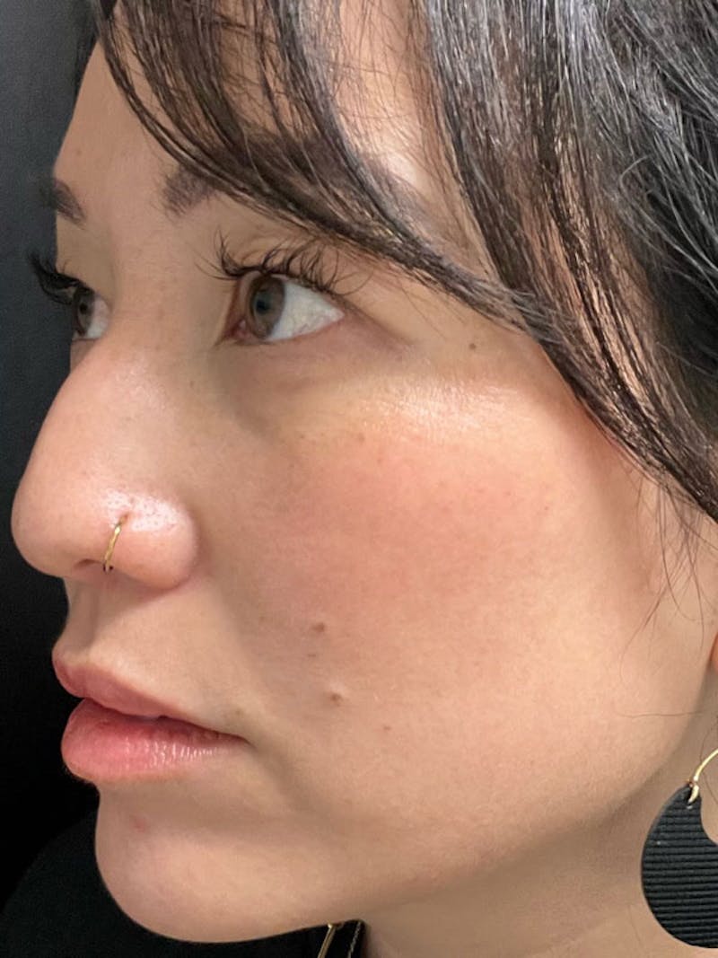 BBL/Moxi Before & After Gallery - Patient 161318315 - Image 6