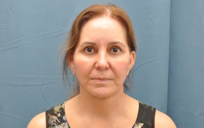 Facelift Before & After Gallery - Patient 176840239 - Image 2