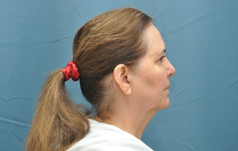 Facelift Before & After Gallery - Patient 176840239 - Image 5