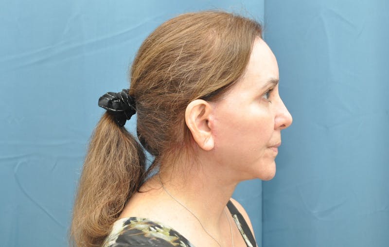 Facelift Before & After Gallery - Patient 176840239 - Image 6