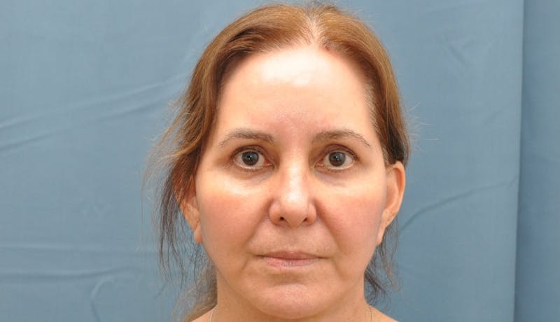 Blepharoplasty Before & After Gallery - Patient 176840644 - Image 2