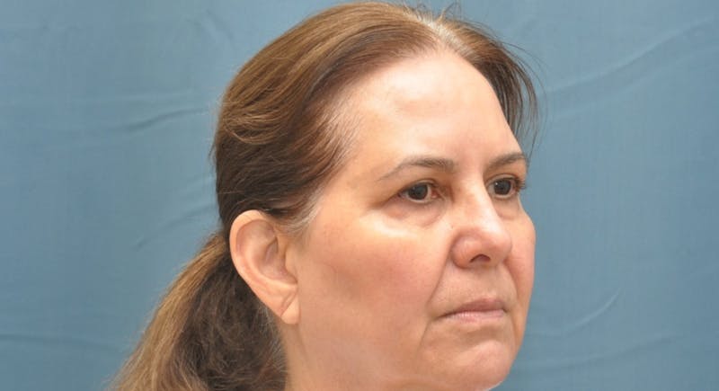 Blepharoplasty Before & After Gallery - Patient 176840644 - Image 3