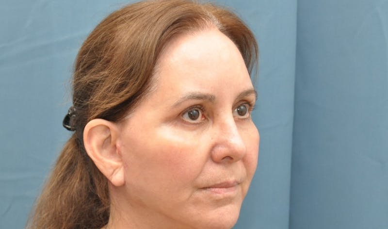 Blepharoplasty Before & After Gallery - Patient 176840644 - Image 4