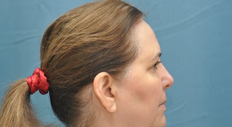 Blepharoplasty Before & After Gallery - Patient 176840644 - Image 5