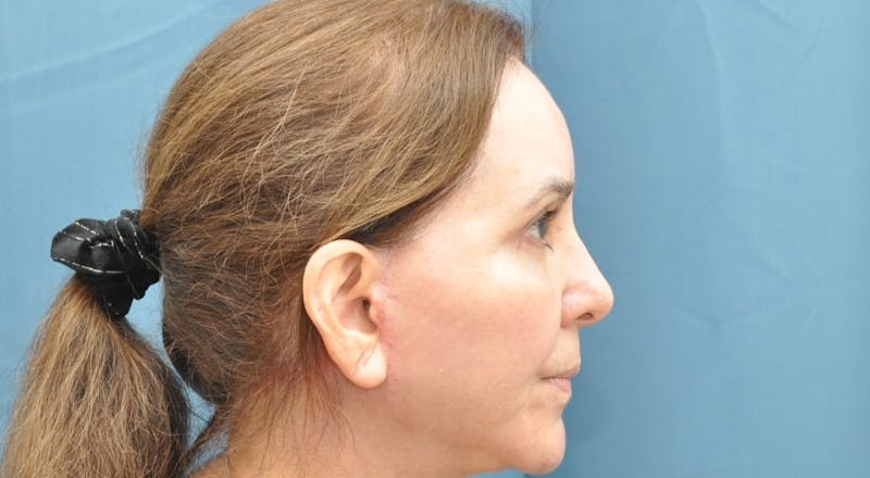 Blepharoplasty Before & After Gallery - Patient 176840644 - Image 6