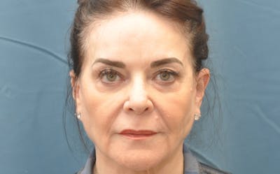Brow Lift Before & After Gallery - Patient 180865614 - Image 1