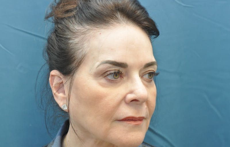 Brow Lift Before & After Gallery - Patient 180865614 - Image 3