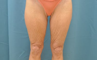 Thigh Lift Before & After Gallery - Patient 188666043 - Image 1