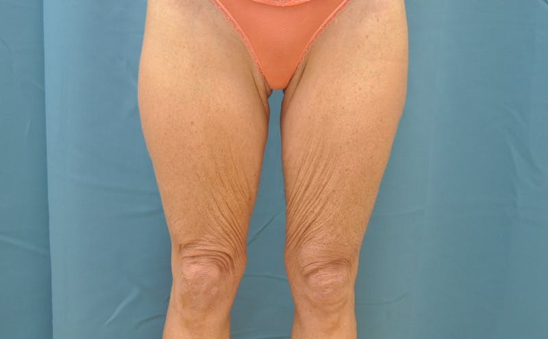 Thigh Lift Before & After Gallery - Patient 188666043 - Image 1