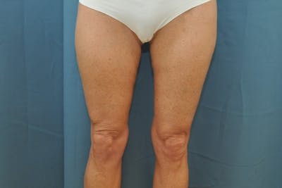 Thigh Lift Before & After Gallery - Patient 188666043 - Image 2
