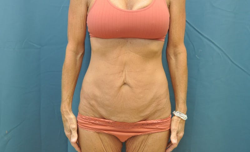 Tummy Tuck Before & After Gallery - Patient 188666090 - Image 1