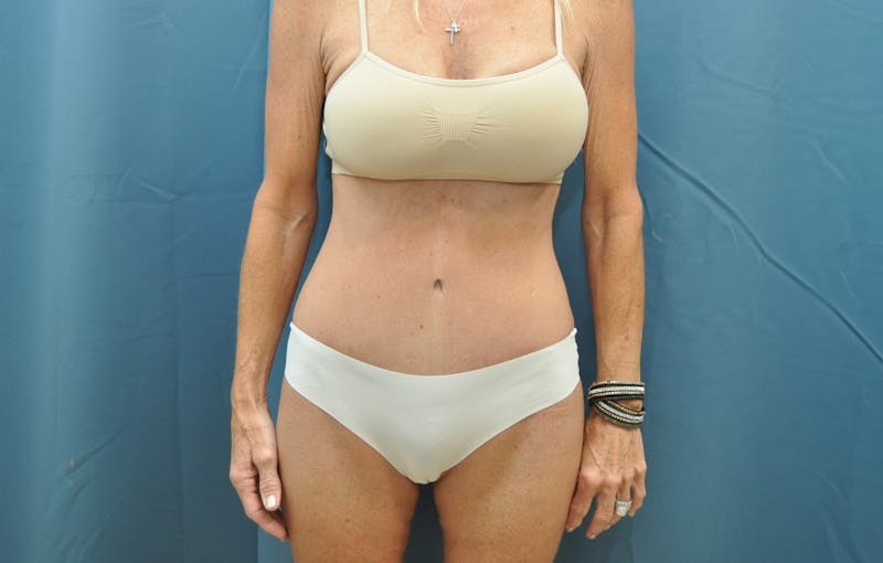 Tummy Tuck Before & After Gallery - Patient 188666090 - Image 2