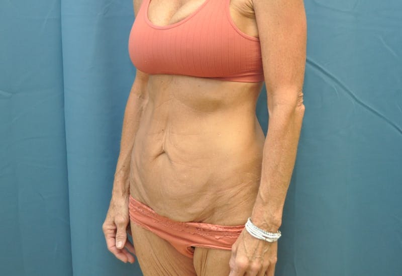 Tummy Tuck Before & After Gallery - Patient 188666090 - Image 5