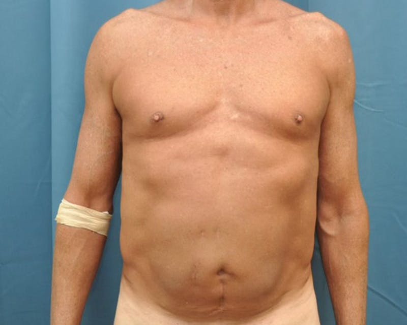 Tummy Tuck Before & After Gallery - Patient 280735 - Image 1
