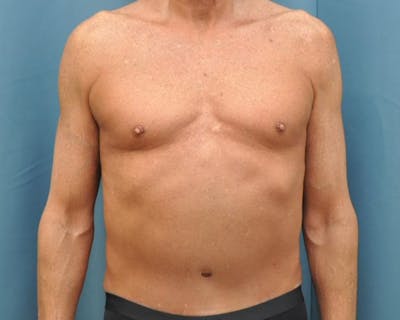 Tummy Tuck Before & After Gallery - Patient 280735 - Image 2