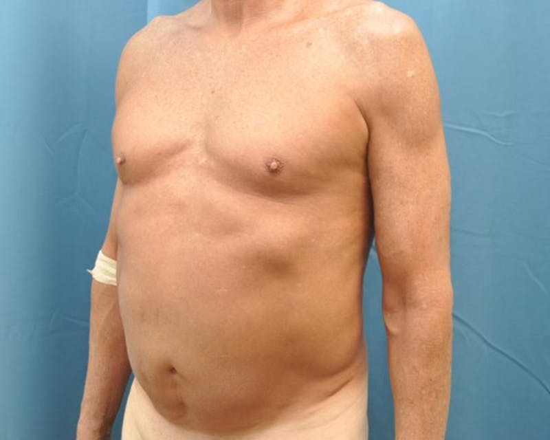 Tummy Tuck Before & After Gallery - Patient 280735 - Image 3
