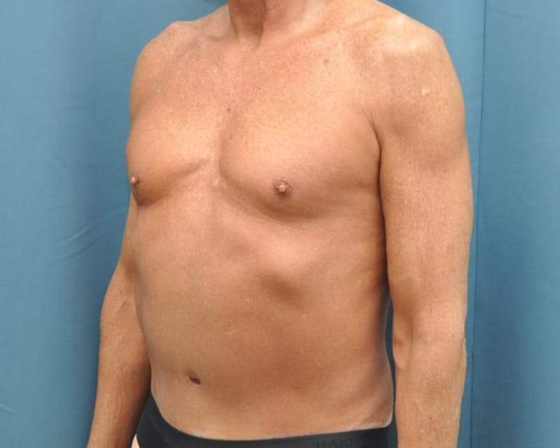 Tummy Tuck Before & After Gallery - Patient 280735 - Image 4