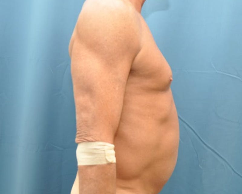 Tummy Tuck Before & After Gallery - Patient 280735 - Image 5