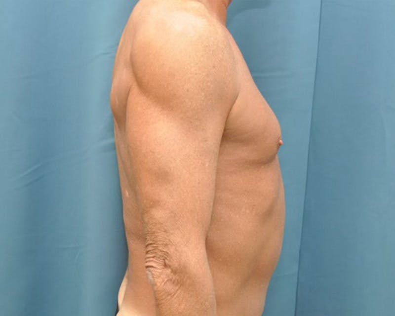 Tummy Tuck Before & After Gallery - Patient 280735 - Image 6